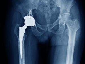 Primary Total Hip Replacements